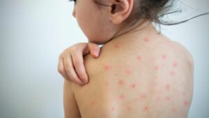 chickenpox vaccine nottingham